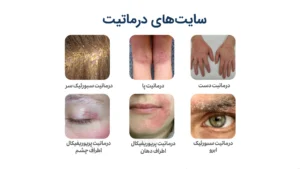 انواع درماتیت تماسی و علل بروز آن