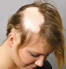 بررسی علل و درمان‌ های مختلف آلوپسی آره‌ آتا