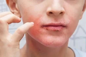 تغییرات سبک زندگی و تأثیر آن‌ها بر اگزما