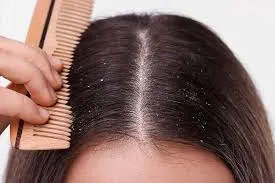 بررسی علل و درمان‌ های مختلف شوره سر