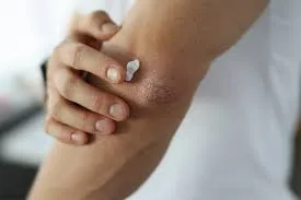 تأثیرات خشکی پوست