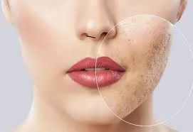 اثربخشی مزوتراپی برای مشکلات پوستی